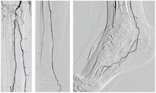 Figure 1. Diagnostic angiogram: ATA CTO, patent PTA, patent PER, and patent LPA. ATA = anterior tibial artery; CTO = chronic total occlusion; PTA = posterior tibial artery; PER = peroneal; LPA = lateral plantar artery.