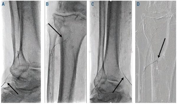 Figure 3. Arrow (A) retrograde ATA access, (B) retrograde wire looped at ATA ostium, (C) retrograde PT access, (D) retrograde PTA crossed into proximal ATA. PT = posterior tibial; PTA = posterior tibial artery; ATA = anterior tibial artery.