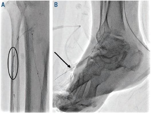 Tibbs Arterielle Kanüle – GVBM mbH