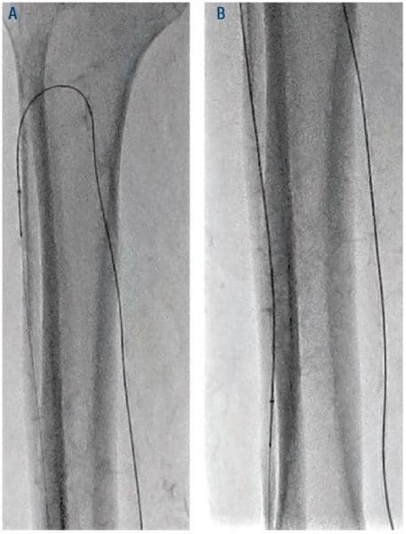 Figure 5. Atherectomy of ATA through PTA access with 1.5 Classic CSI catheter. ATA = anterior tibial artery; PTA = posterior tibial artery; CSI = Cardiovascular Systems, Inc.