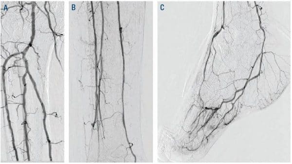 Figure 8. Final result revealed 3-vessel run-off with an intact plantar loop.