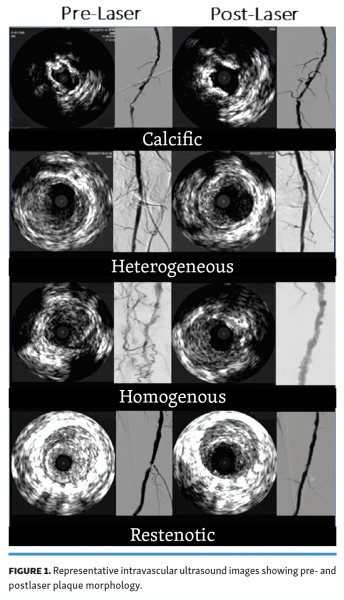 prelaser-and-postlaser-plaque-morphology